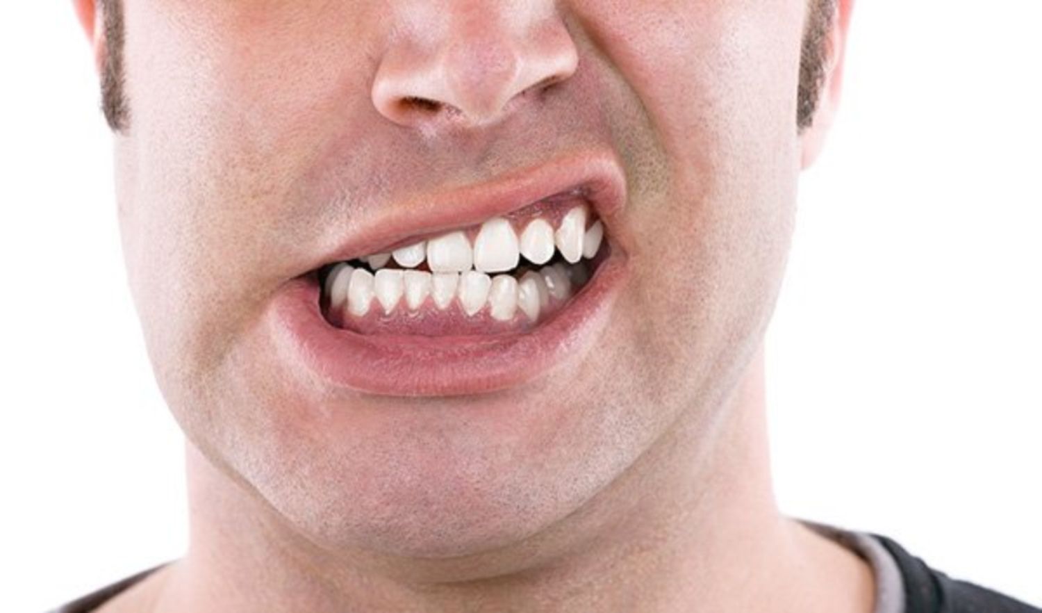 bệnh nghiến răng